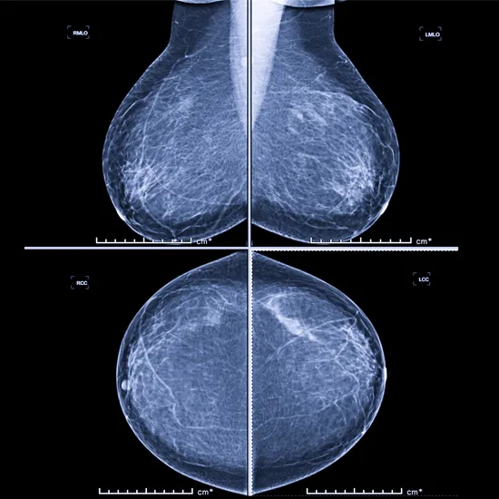 mammography x-ray both side breast